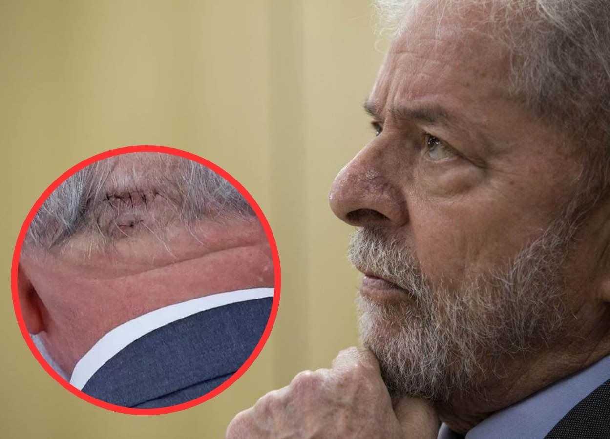 presidente-lula-cirurgia